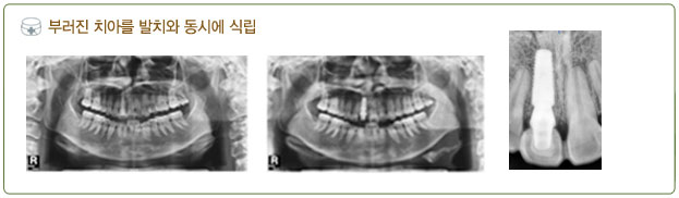 즉시 임플란트