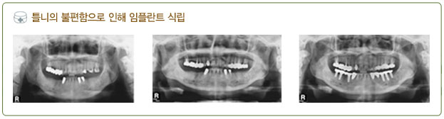 틀니 임플란트