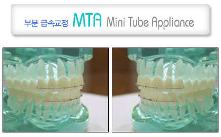 부분 급속 교정 MTA(Mini Tube Appliance)이란?